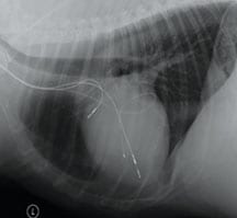 Black and white side-view radiograph of a chest with thin wire-like lines across it
